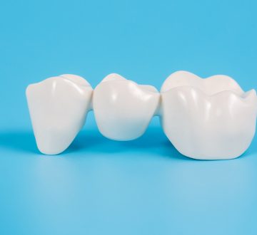 Types of Dental Bridges