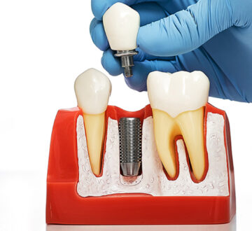 Types of Dental Implants Available in Tampa: Which One is Right for You?